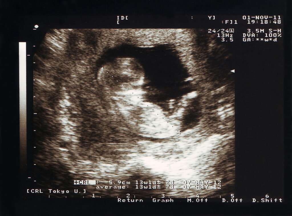 ultrasound image